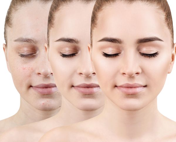Acne (Pimples) Scar Treatment